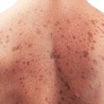 Disponible en toda Cuba fármaco para el tratamiento del cáncer de piel