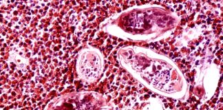 La amenaza de los gusanos de la esquistosomiasis, la enfermedad emergente que ya se ha transmitido en España